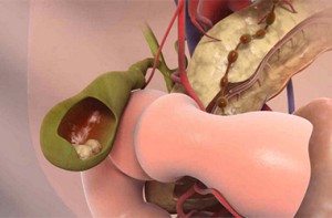 Заболевание желчного пузыря