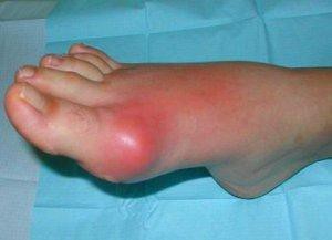 Питание при артрите