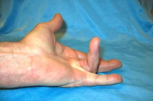 Операция при контрактуре Дюпюитрена