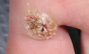 Лечение подошвенной бородавки в домашних условиях: лучшие народные средства