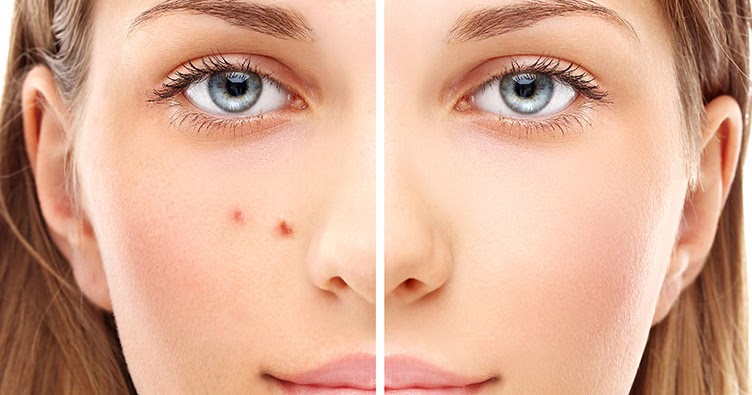 Способы восстановления после тяжелого акне