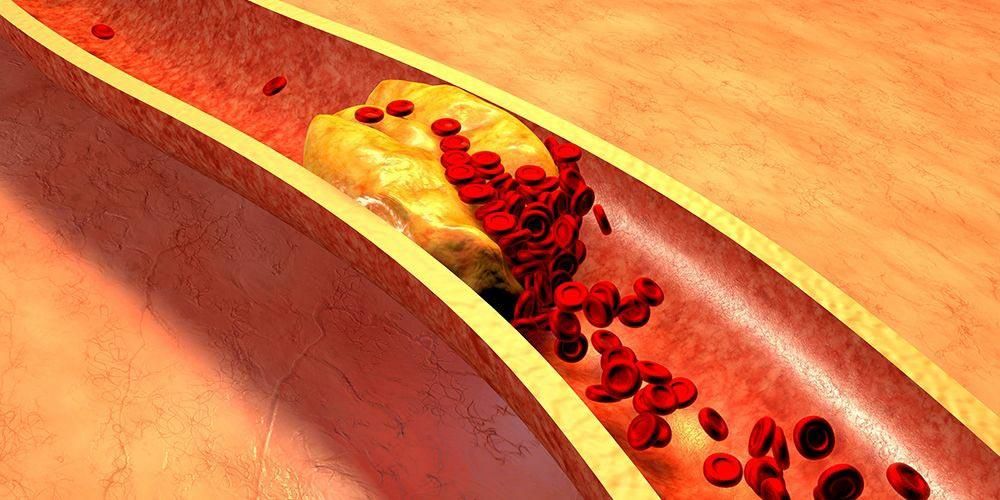 6 неочевидных признаков забитых сосудов