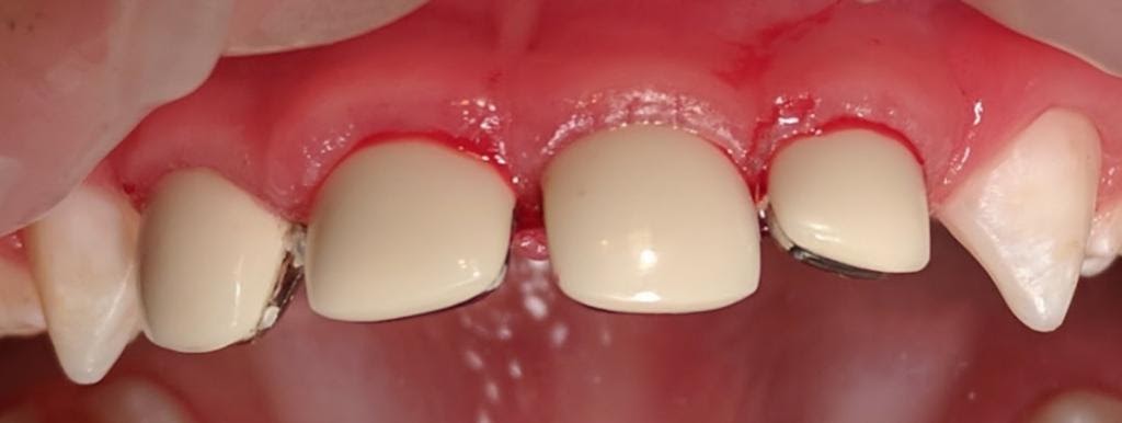 Коронки на молочные зубы