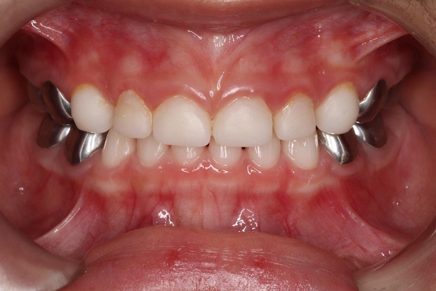 Коронки на молочные зубы