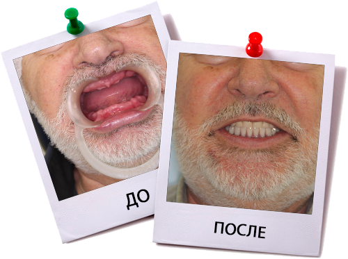 Современные технологии имплантации зубов