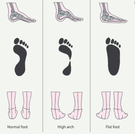 Как предотвратить плоскостопие у детей: советы врача ортопеда