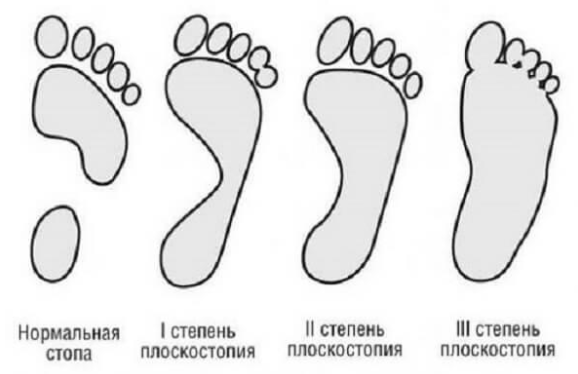 Как предотвратить плоскостопие у детей: советы врача ортопеда