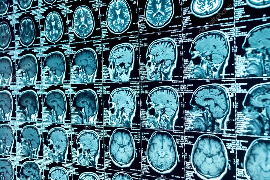 МРТ головного мозга