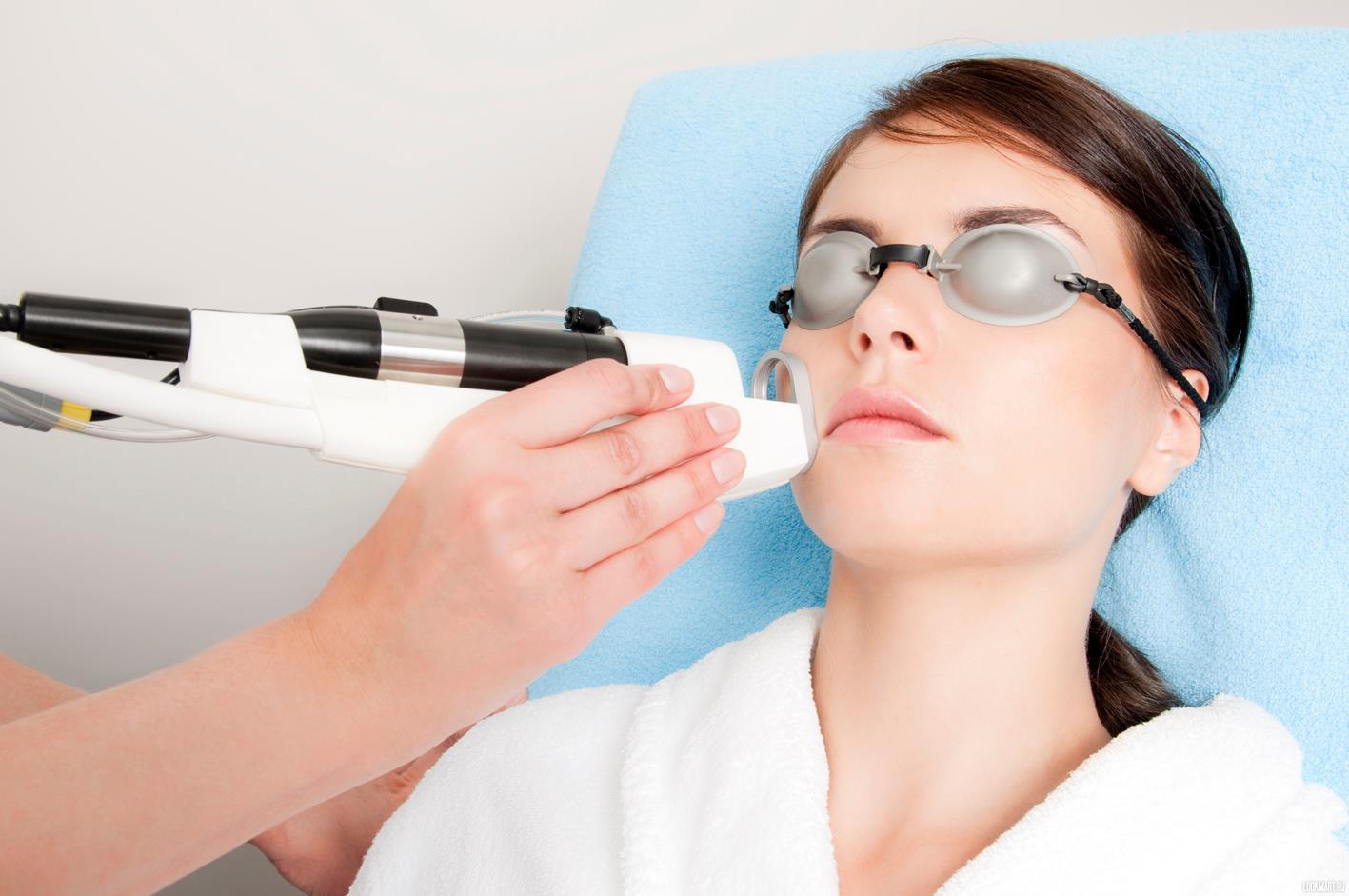 Что такое фотокоагуляция сосудов на лице