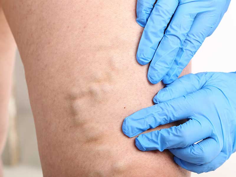 Варикозное расширение вен