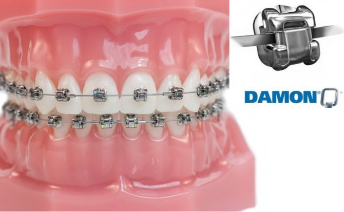 Брекеты Damon Clear: виды, особенности, и этапы лечения
