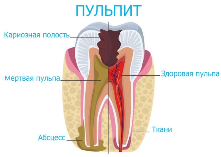 Пульпит: помощь и лечение