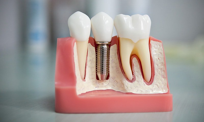 Протезирование зубов