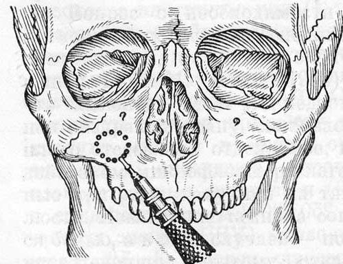 Как проводят гайморотомию