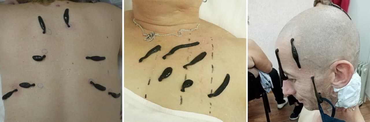 Гирудотерапия в реабилитации пациентов, перенесших коронавирусную инфекцию COVID-19.