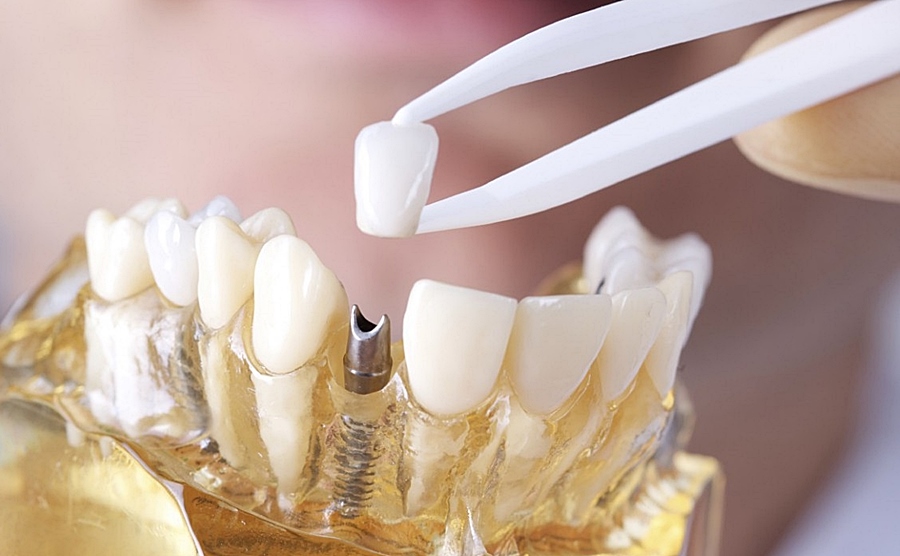 Больно ли ставить коронку на зуб?