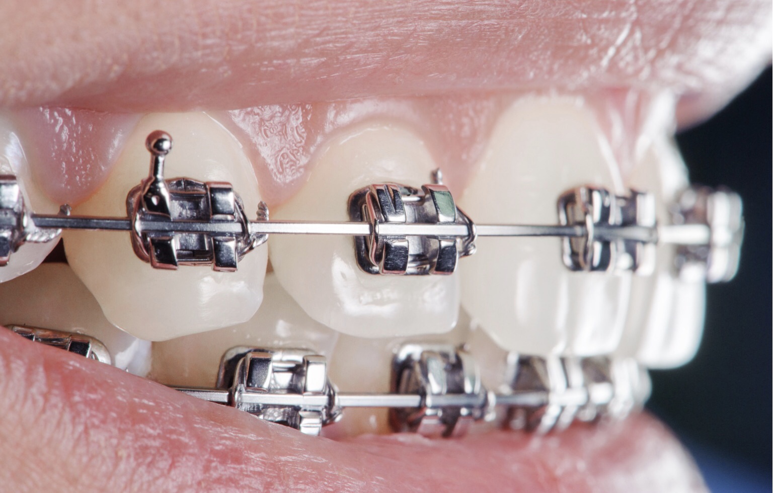 Как выбрать брекеты