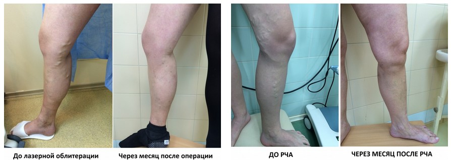 Врач флеболог и его специализация