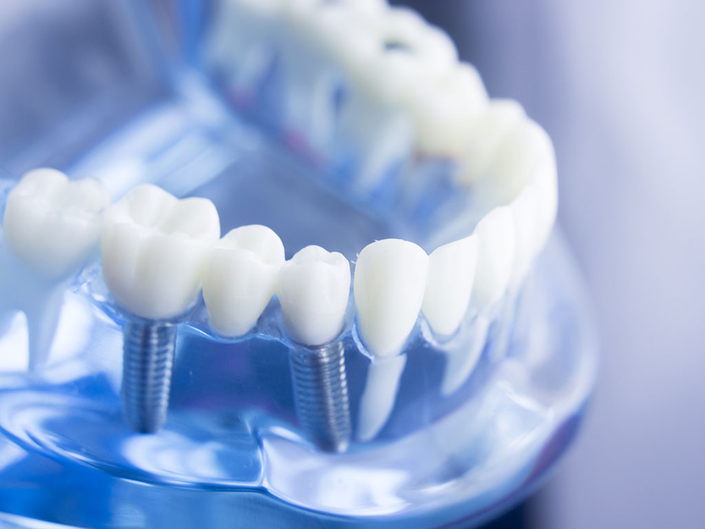 Что такое протезирование и как оно проводится