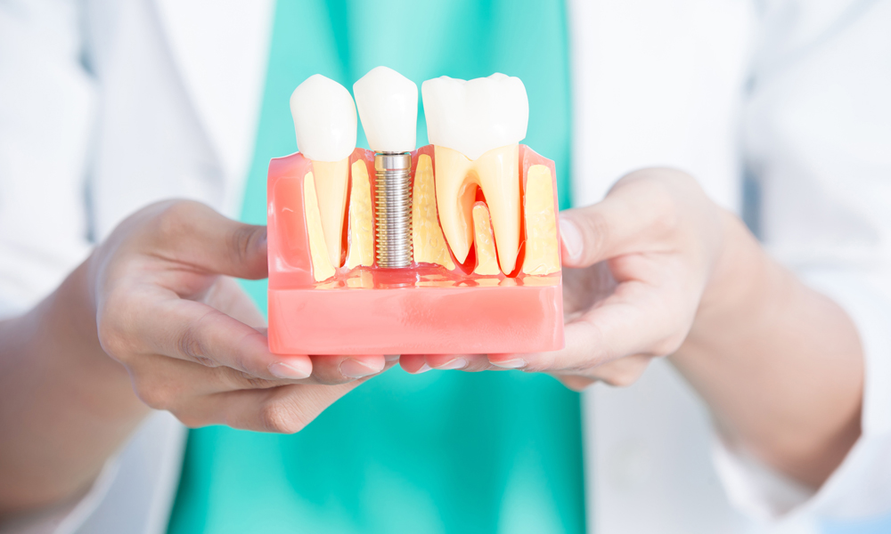 Из чего формируется цена на имплантаты зубов