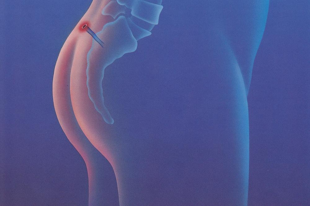 Что такое эпителиальный копчиковый ход?