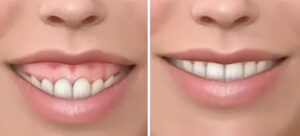 Особенности десневой улыбки: Природа, эстетика и серьезные