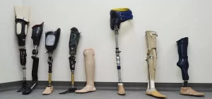 Преимущества и особенности протезирования конечностей: Возвращение к активной жизни