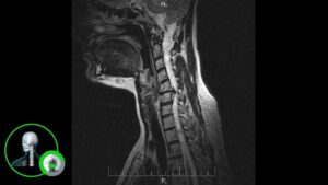 Важность МРТ шейного отдела позвоночника: диагностика, предотвращение и лечение