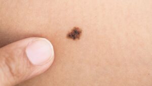 Удаление родинок - методы, и для чего проводится процедура