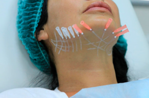 Нитевой лифтинг лица: Почему стоит выбрать эту процедуру для омоложения