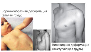 Какую болезнь называют куриная грудь?