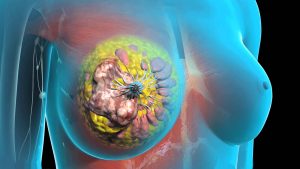 Рак молочной железы: как лечить и восстановить здоровье