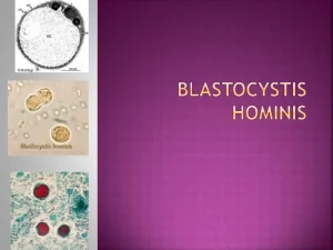Бластоцистоз: Понимание, Симптомы и Лечение