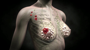 Гормональная терапия рака молочной железы