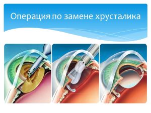 Замена хрусталика глаза: Современные Прогрессивные Технологии, Открывающие Новые Горизонты Зрения