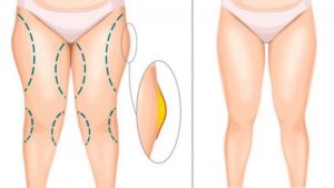 Липосакция бедер: Все, что нужно знать о процедуре