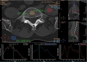 КТ-Денситометрия Костей: Современные Технологии в Диагностике Остеопороза