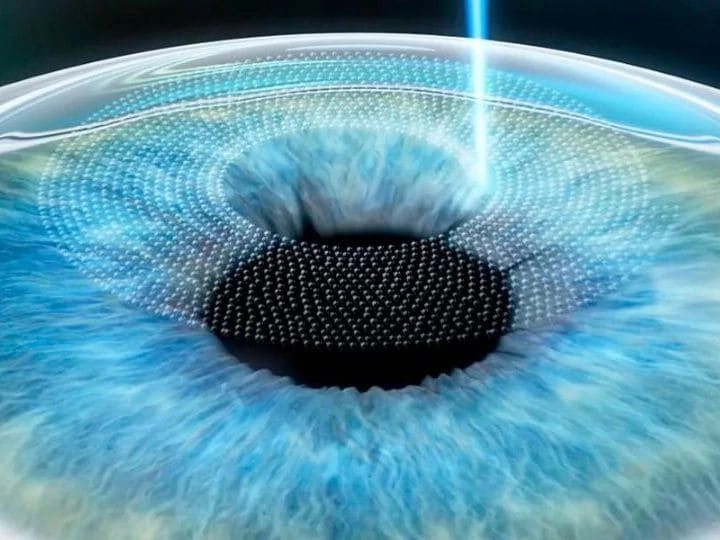 Лазерная коррекция зрения: как это работает и кому подходит