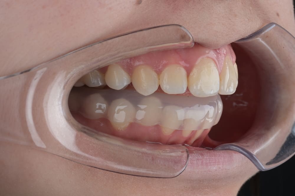 Что такое сплинт-терапия ВНЧС?