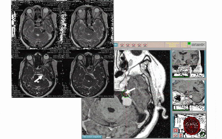 Невралгия тройничного нерва: Симптомы, причины и методы лечения
