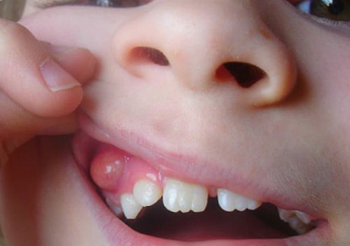 Лечение кисты зуба: что нужно знать