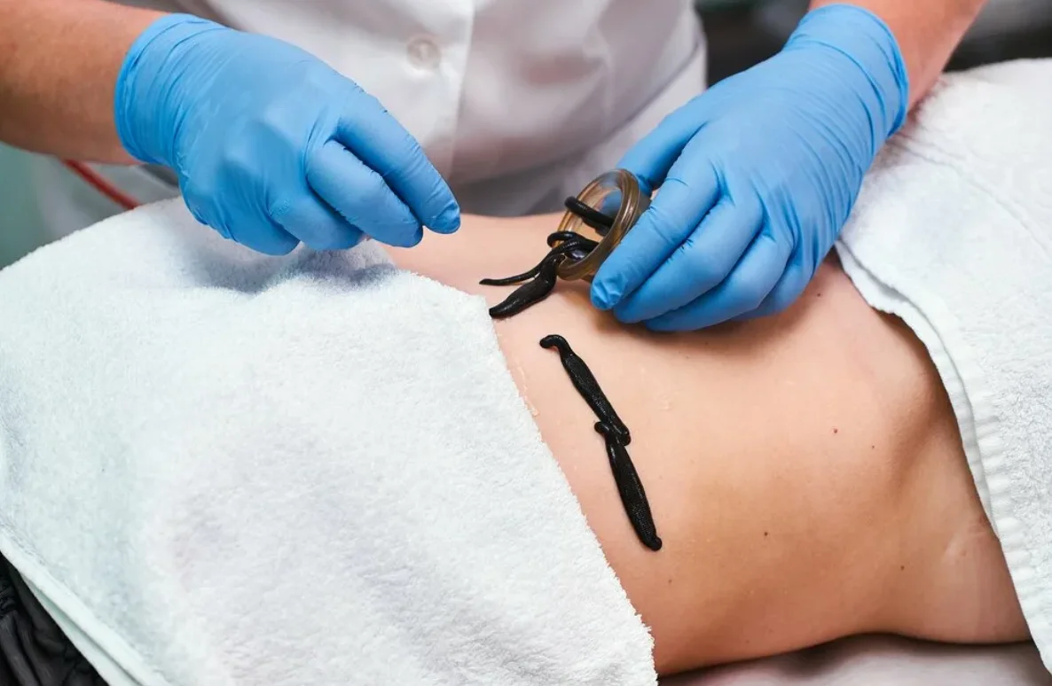 Цена лечения пиявками в Балашихе: насколько доступно эффективное восстановление без таблеток?