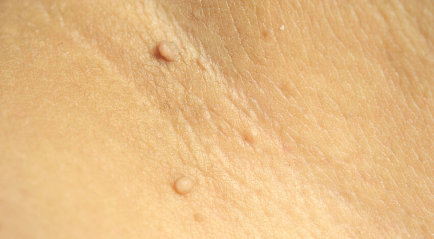 Удаление папиллом лазером