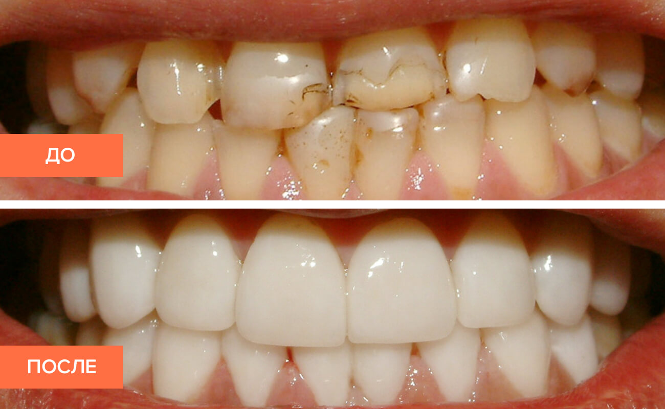 Может ли под винирами образовываться кариес?