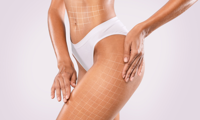 Что Такое RF-лифтинг и Как Он Работает?