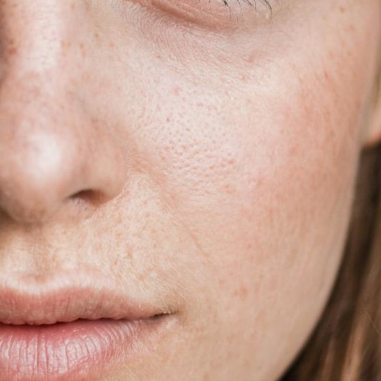 Как и почему появляются пигментные пятна на коже