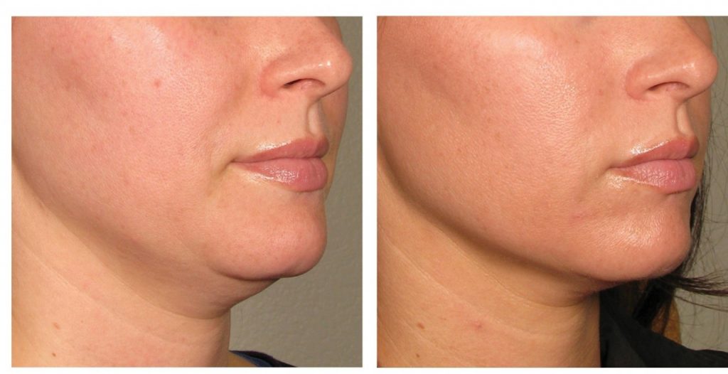 Процедура для тех, кто в деле: коррекция фигуры с Contourslim для активных женщин, у которых нет времени на долгий уход