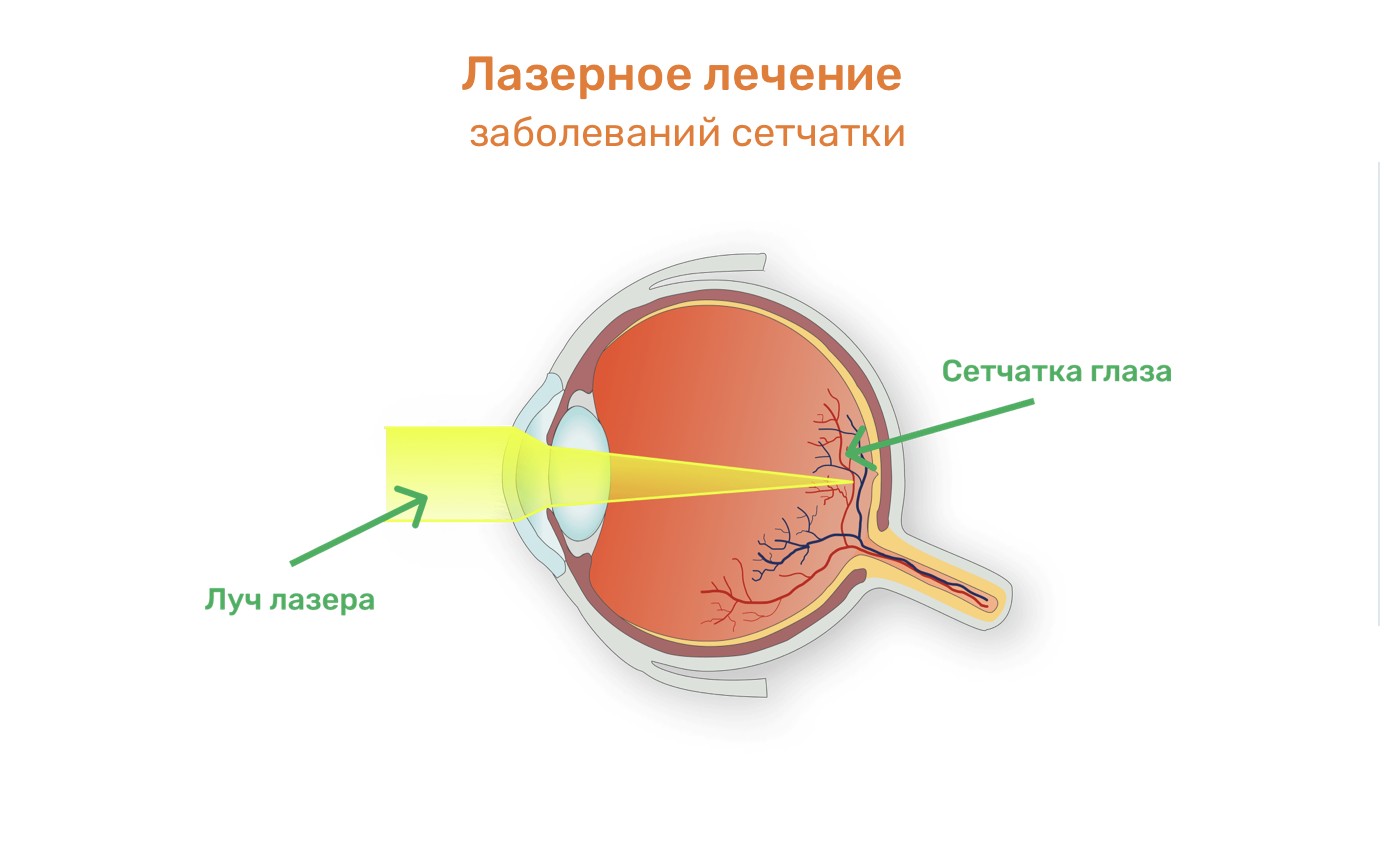 Боремся за зрение: Современные подходы к лечению заболеваний сетчатки