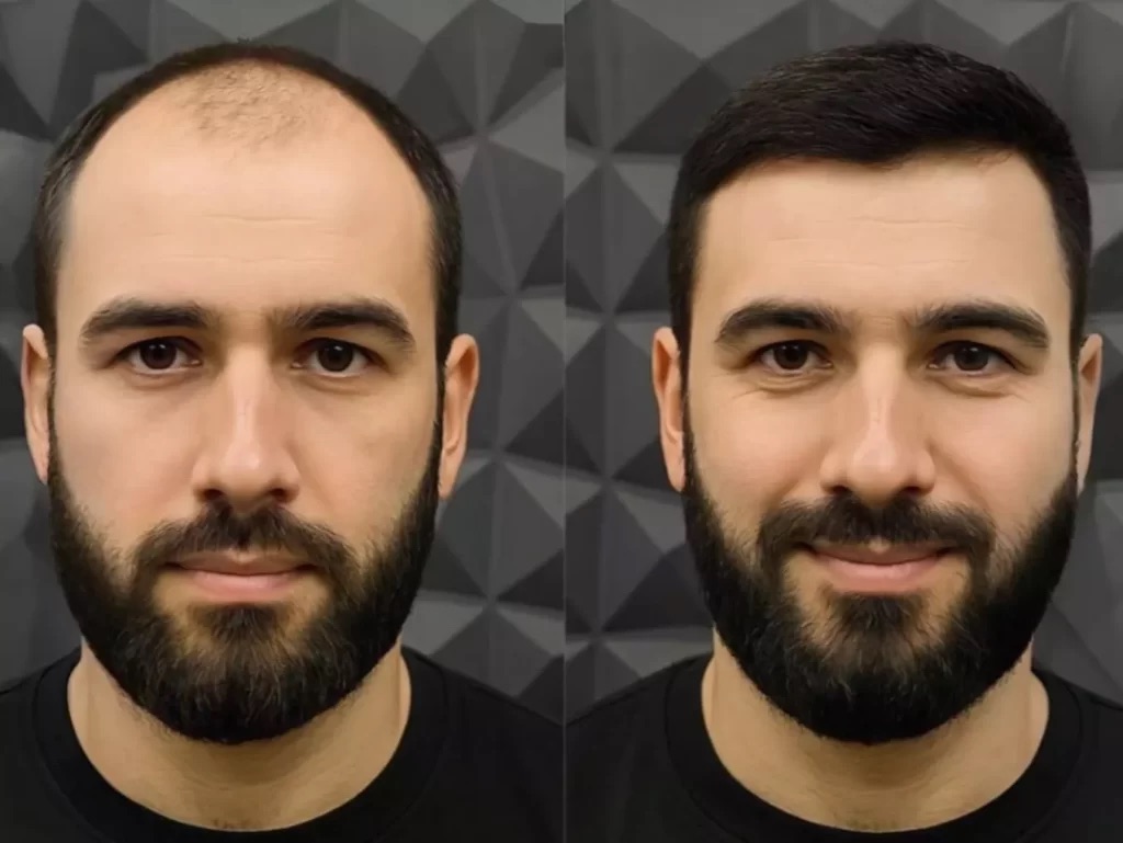 Как проходит процедура по пересадке волос