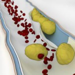 Как быстро почистить сосуды головного мозга народными средствами? Чистка сосудов головного мозга